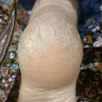 تخفیف پدیکور تخصصی پارافین تراپی روشن سازی دست ها