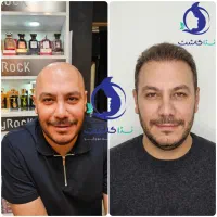 کاشت موی طبیعی و پرتراکم قیمت نهایی و قطعی