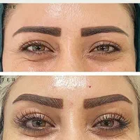 بوتاکس و فیلر و بایوفیلر
