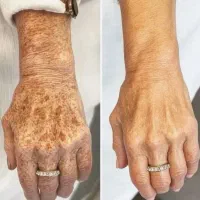 بیوممتیک ضدلک رفع لک به صورت تضمینی