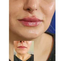 تزریق ژل و بوتاکس
