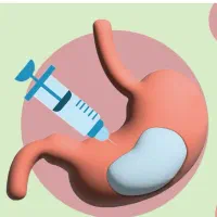 بوتاکس معده روش غیرحراحی لاغری