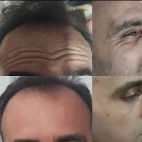 آف فیلر وبوتاکس تضمینی(خانمهاوآقایان)