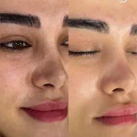 جوانسازی صورت به همراه جوانسازی دست ۵۹۰ت