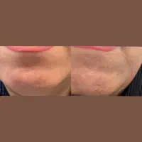 مزوتراپی &  PRP|خدمات آرایشگری و زیبایی|بندر انزلی, شاکوچه|دیوار
