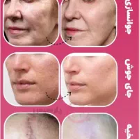 هایفوتراپی و آر اف ۷بعدی اولترا