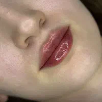 جشنواره تزریق فیلر لب در چابکسر