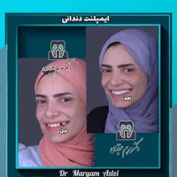 پایتخت ایمپلنت دندان دندانپزشکی تضمینی تعرفه دولتی