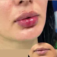 ژل فیلر و پیرسینگ با ۵۰ درصد آف