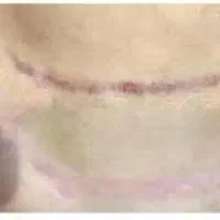 پاک کردن رد عمل.ابدو.لیپو.خودزنی.ترک شکم وبدن|خدمات آرایشگری و زیبایی|مشهد, هنرستان|دیوار