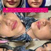 مطب زیبایی لیزر بوتاکس ژل مزو نخ لک جوش|خدمات آرایشگری و زیبایی|لردگان, |دیوار
