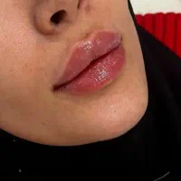 ژل بوتاکس|خدمات آرایشگری و زیبایی|جیرفت, |دیوار