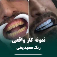 کامپوزیت و بلیچینگ از فکی ۴۸۰۰