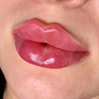 لیفت نخ انزیم ژل وبوتاکس پلاسما تتوبدن فشیال...|خدمات آرایشگری و زیبایی|قم, باجک دو|دیوار