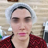 (کلینیک دنا) تنها هایفو۱۲بعدی یاسوج|خدمات آرایشگری و زیبایی|یاسوج, |دیوار