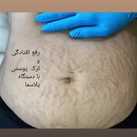 لیزرمیکرو پلاسمالیفت زیبایی/ بینی شیک/بلفاروپلاستی|خدمات آرایشگری و زیبایی|کرمانشاه, |دیوار