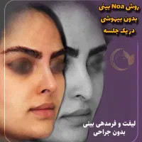 آف رینوپلاستی بینی بدون عمل جراحی NOA پزشک زیبایی|خدمات آرایشگری و زیبایی|مشهد, هفت تیر (آب و برق)|دیوار