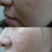 تخفیف ویژه پی آر پی، مزوتراپی، اگزوزوم، گلوتاتیون|خدمات آرایشگری و زیبایی|شیراز, قصرالدشت|دیوار