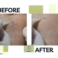 درمان واریس توسط متخصص عروق با لیزرو دارو امریکایی