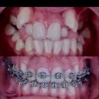 دندانپزشکی اقساطی بدون چک(ارتودنسی وکاشت)دندان