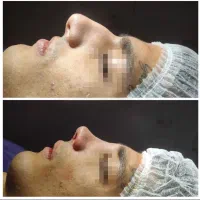 جراحی زیبایی بینی|خدمات آرایشگری و زیبایی|امامزاده عبدالله, |دیوار