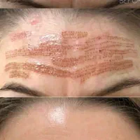 حذف انواع خال وکک ومک،میلیا ،زگیل وچین وچروک