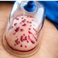 آموزش کارگاهی صفر تا صدحجامت و زالو درمانی|خدمات آموزشی|ارومیه, |دیوار