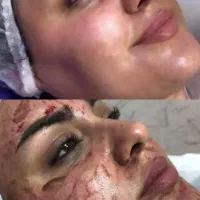 درمان قطعی مشکلات پوست در ۳جلسه کلینیکی