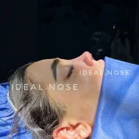 جشنواره عمل بینی (تخفیف ویژە )