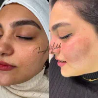 حذف دائمی لک و کک مک گلسار کلینیک
