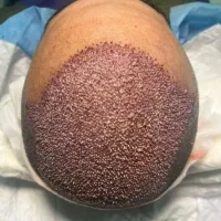 کاشت مو شیراز/انتخاب مطمئن مراجعین کرمان/۲۰ میلیون