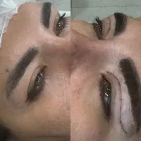 بلفاروپلاستی اتوپلاستی تیپ پلاستی سانترال لب