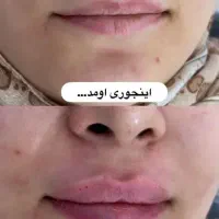 جشنواره فیلربادی،هایفو غبغب لیزر موهای زاید