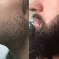 کاشت ریش طبیعی