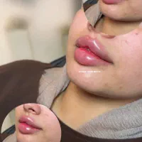 تزریق ژل و بوتاکس و شاین بادی|خدمات زیبایی و سلامت|تبریز, |دیوار
