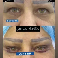 جشنواره بلفاروپلاستی و دیگر خدمات زیبایی|خدمات آرایشگری و زیبایی|کرمانشاه, |دیوار