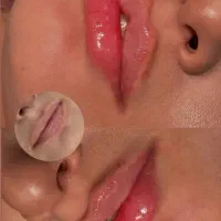 تزریق ژل و بوتاکس
