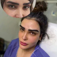 میکروکاشت با و بدون جراحی نقد و اقساط|خدمات آرایشگری و زیبایی|یاسوج, |دیوار