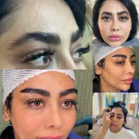 کاشت مو وابرو بدون سیخ سیخ شدن وبهترین خواب|خدمات آرایشگری و زیبایی|مشهد, احمدآباد|دیوار