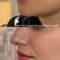 تخفیف ویژه ژل وبوتاکس