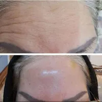 ژل بوتاکس نخ لیفت مزو زاویه|خدمات آرایشگری و زیبایی|تهران, سلسبیل|دیوار