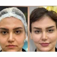 مدل لیفت و زیباسازی و شفاف سازی چهره به مدت محدود