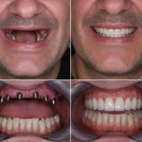 ایمپلنت دیجیتال با ضمانت ۱۶۹۰۰/ دندانپزشکی