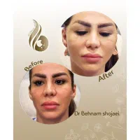 تخفیف ۵۰ درصدی مکس لیفت به مدت محدود