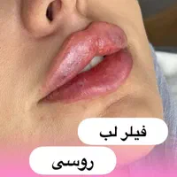 تزریق فیلر و بوتاکس|خدمات آرایشگری و زیبایی|اهواز, گلستان|دیوار