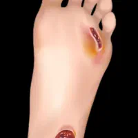 پانسمان نوین ودرمان زخم بستر،زخم دیابتی،سوختگی و..