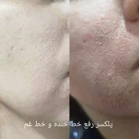 پلکسر وخال برداری ، مزونیدلینگ ، فشیال تخصصی|خدمات آرایشگری و زیبایی|مشهد, طلاب|دیوار