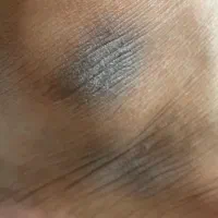 درمان تیرگی های بدن