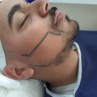 کاشت ریش طبیعی ،با دستگاه جدید کاشت ریش