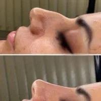 ژل وبوتاکس ومرز وپی آر پی تضمینی 30درصد تخفیف عیدی